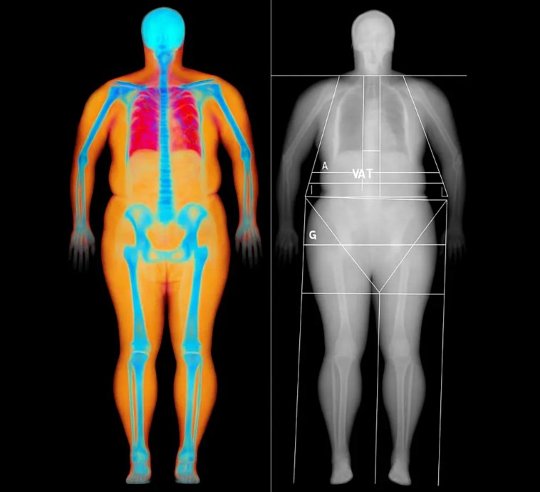 GLP-1 Drugs and Body Composition: Why DEXA Tracking Matters on Ozempic